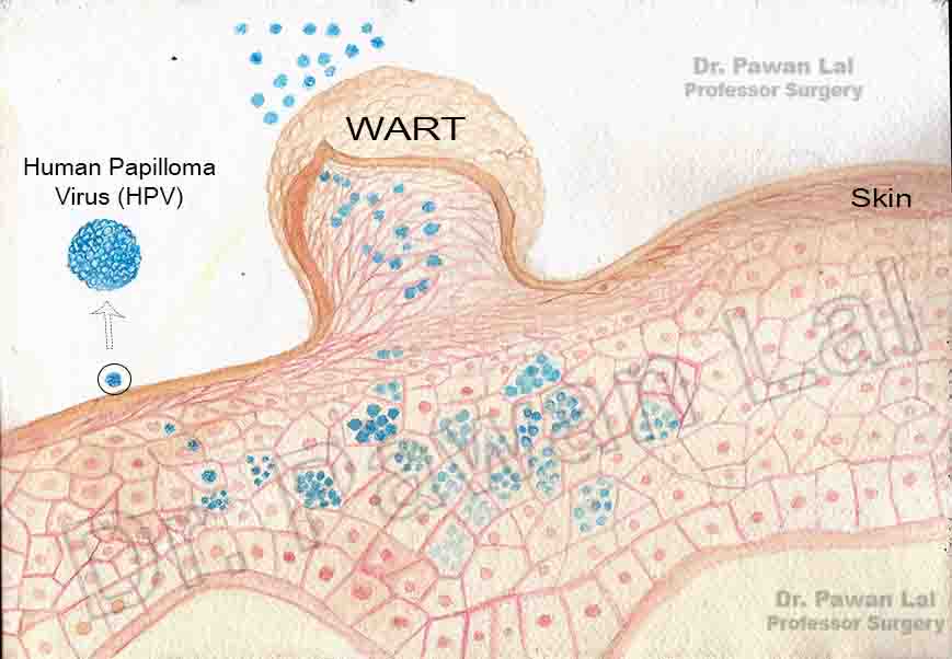 HPV Treatment with Electrocautery